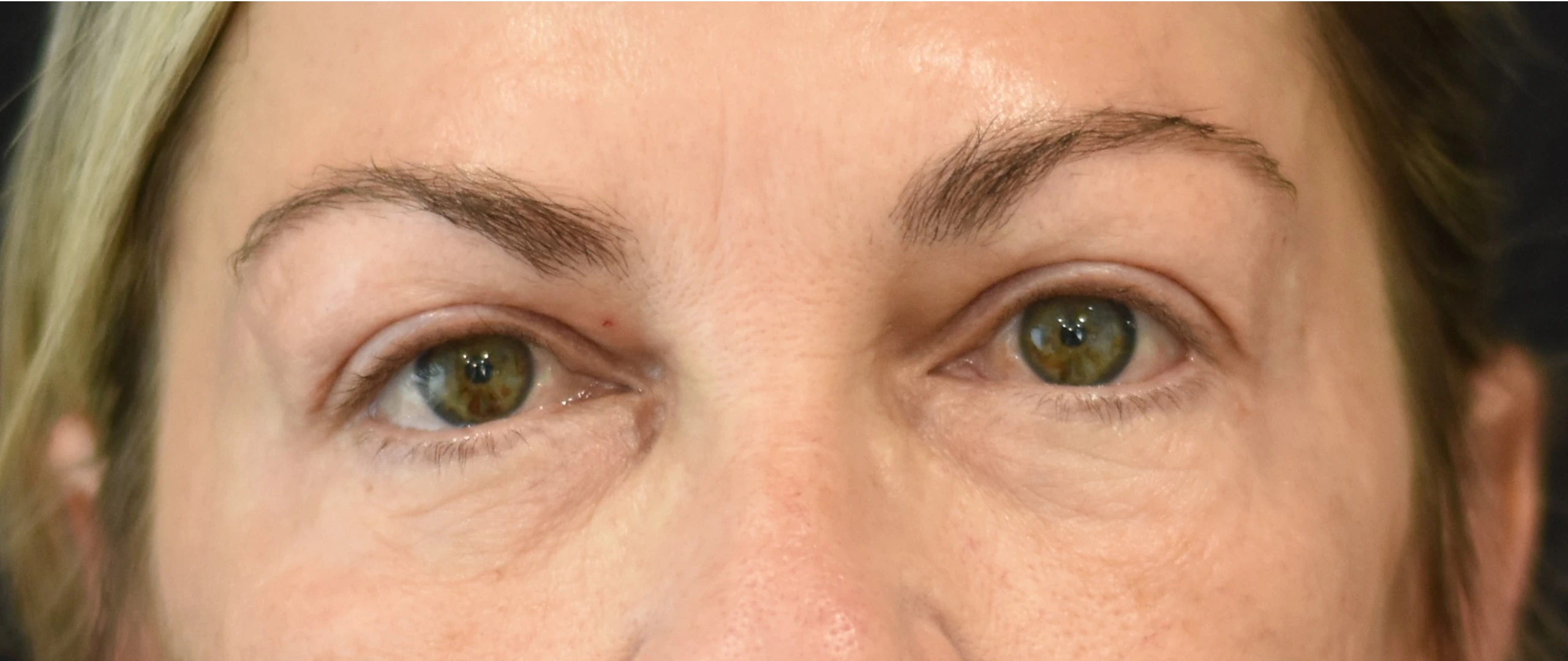 Eyelid Surgery Patient 2 Set 1 After