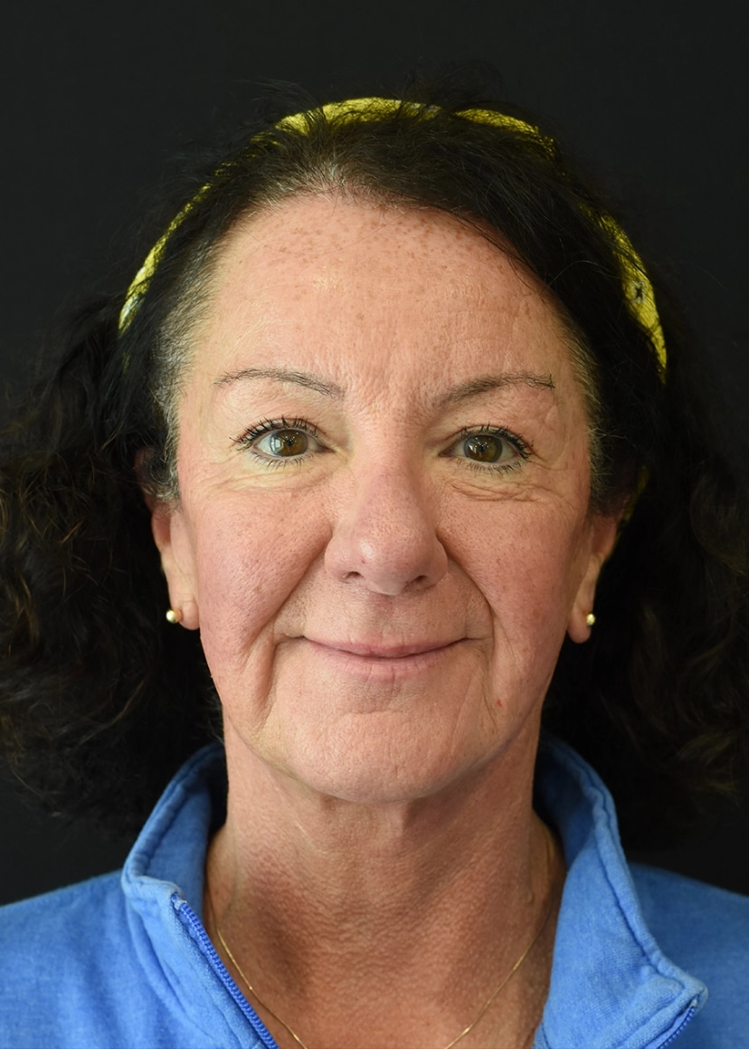 Extended Deep Plane Facelift Patient 5 Set 1 After