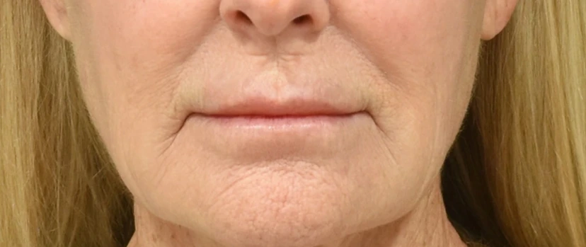 Lip Lift Patient 4 Set 1 Before