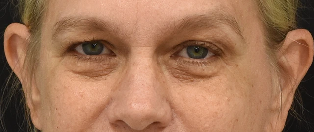Eyelid Surgery Patient 26 Set 1 Before