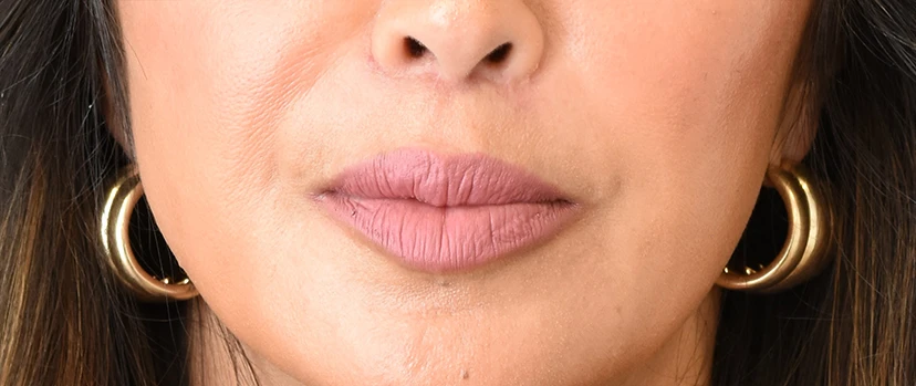 Lip Lift Patient 10 Set 1 After