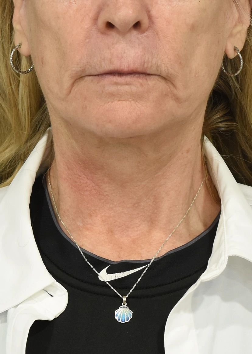 Neck Lift Patient 17 - Set 1 - After